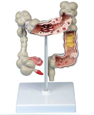 結(jié)腸病變模型.jpg